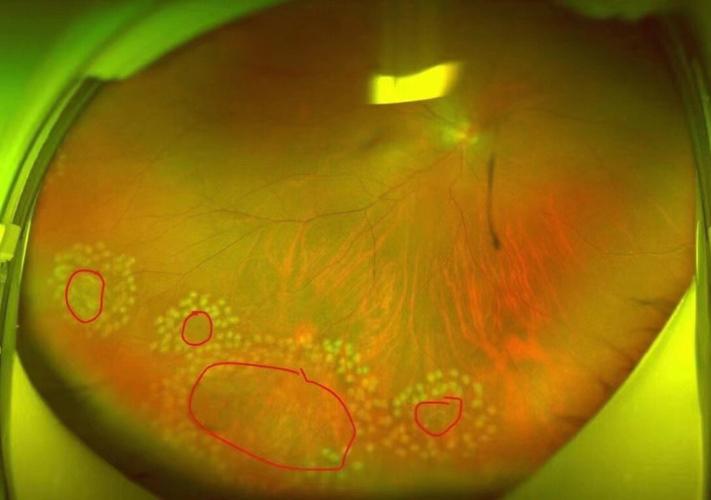 考研女生用眼过度视网膜裂孔，考研女生用眼过度视网膜裂孔l？